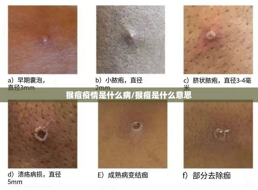 猴痘疫情是什么病/猴痘是什么意思 猴痘疫情是什么病/猴痘是什么意思