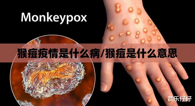 猴痘疫情是什么病/猴痘是什么意思 猴痘疫情是什么病/猴痘是什么意思