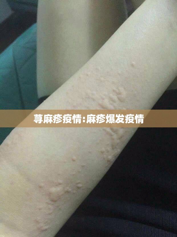 荨麻疹疫情:麻疹爆发疫情