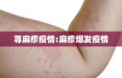 荨麻疹疫情:麻疹爆发疫情