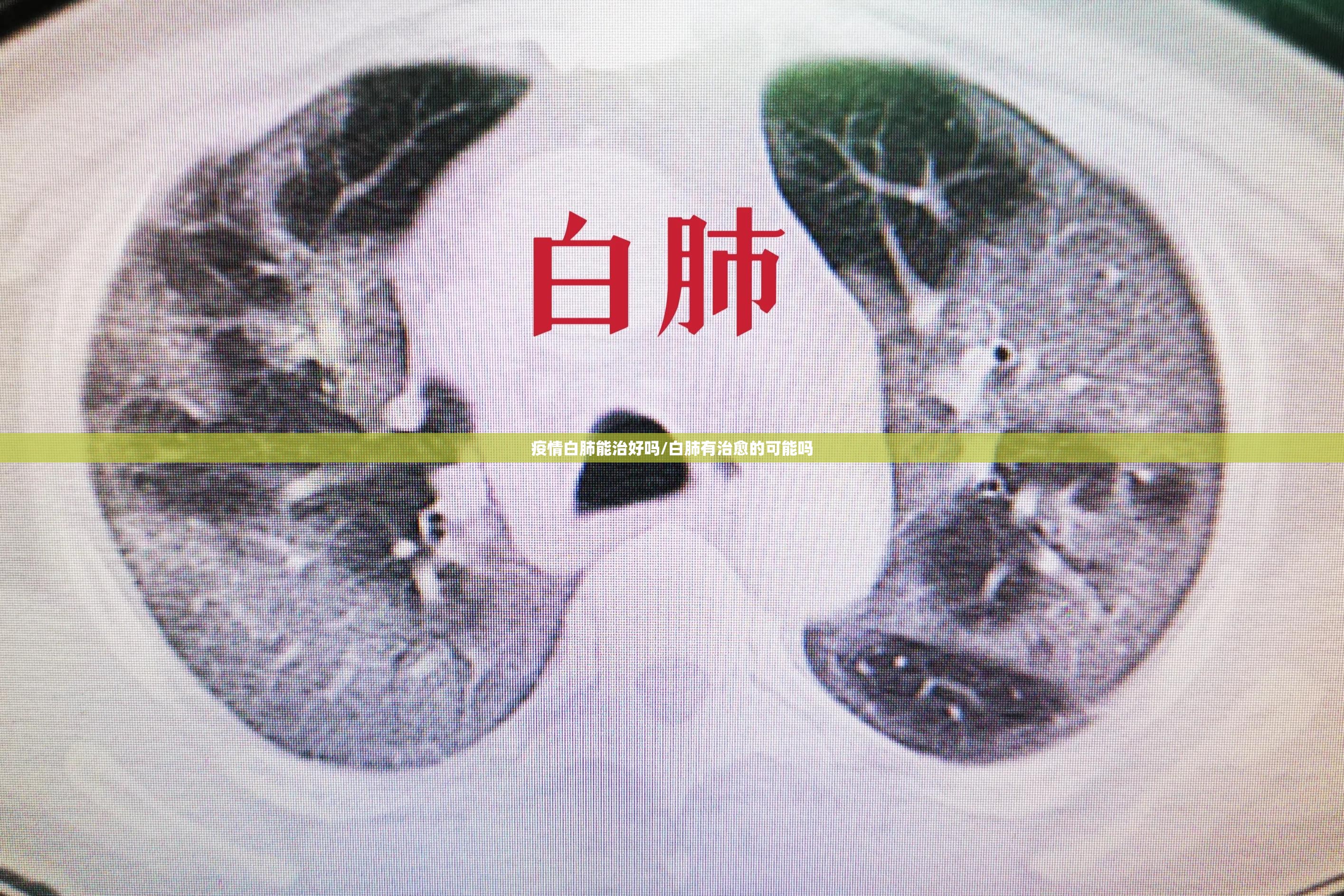 疫情白肺能治好吗/白肺有治愈的可能吗 疫情白肺能治好吗/白肺有治愈的可能吗