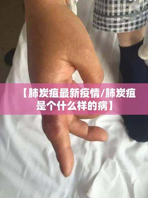 【肺炭疽最新疫情/肺炭疽是个什么样的病】