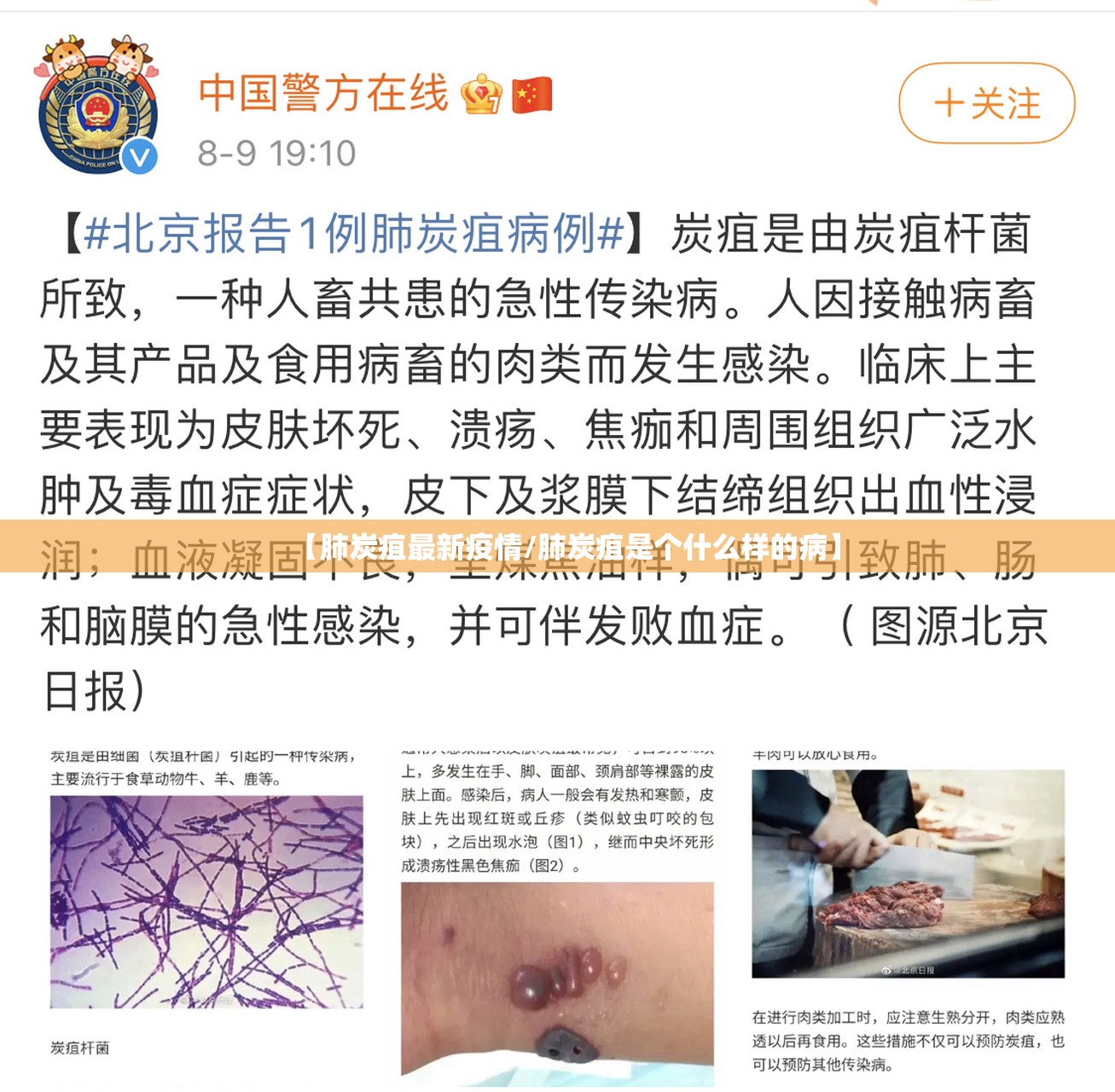 【肺炭疽最新疫情/肺炭疽是个什么样的病】