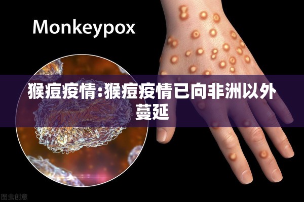 猴痘疫情:猴痘疫情已向非洲以外蔓延 猴痘疫情:猴痘疫情已向非洲以外蔓延