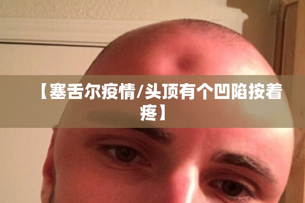【塞舌尔疫情/头顶有个凹陷按着疼】 【塞舌尔疫情/头顶有个凹陷按着疼】
