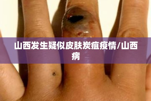 山西发生疑似皮肤炭疽疫情/山西病 山西发生疑似皮肤炭疽疫情/山西病