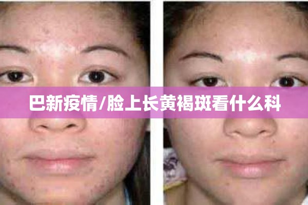 巴新疫情/脸上长黄褐斑看什么科