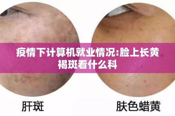 疫情下计算机就业情况:脸上长黄褐斑看什么科